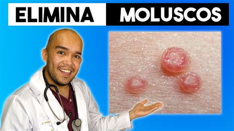 como eliminar molusco contagioso naturalmente|Combate los molestos Moluscos Contagiosos con。